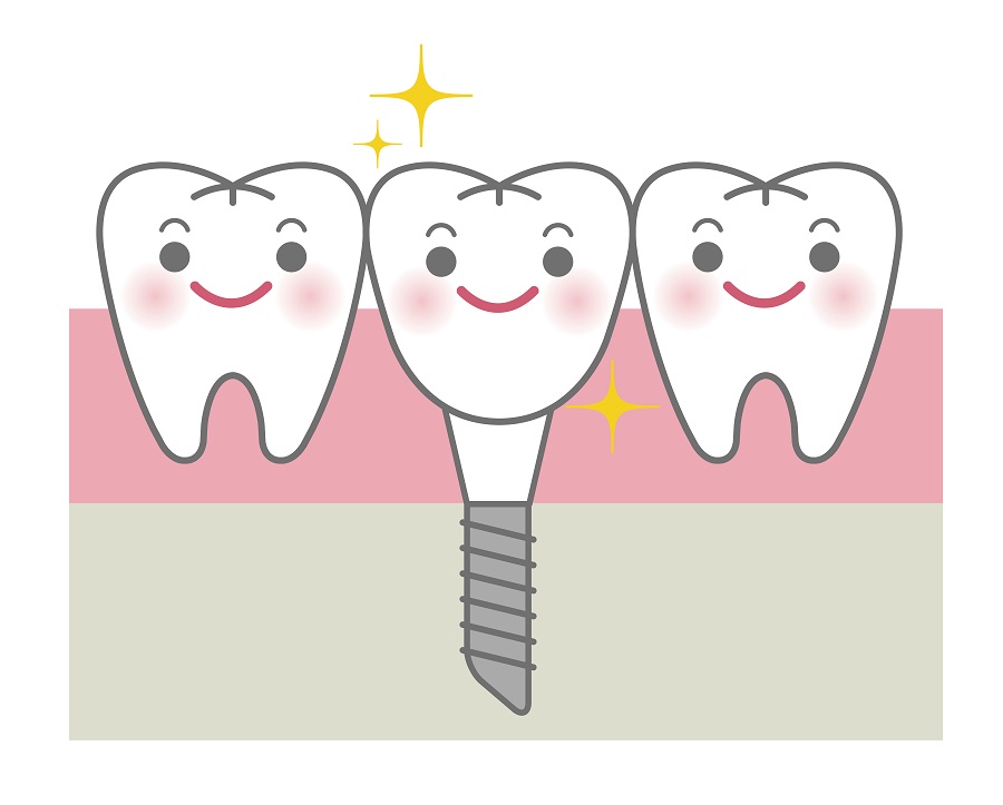 インプラントとは