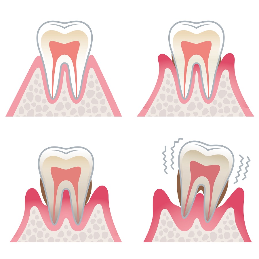 歯周病治療とは